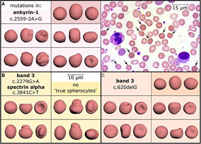 Rare Anemias: Are Their Names Just Smoke and Mirrors?